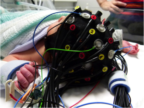 Baby with scan helmet on